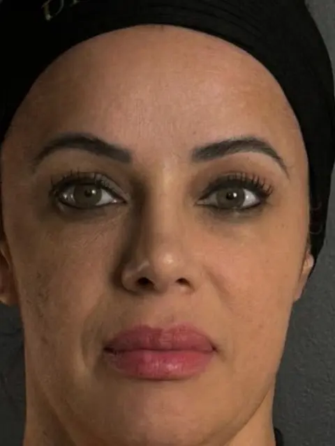 O mesmo rosto com o nariz mais fino, simulação de rinoplastia por IA